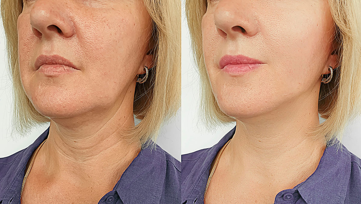 Botox-And-Fillers-Before-After