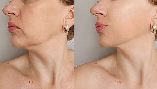 lower chin wrinkles and folds