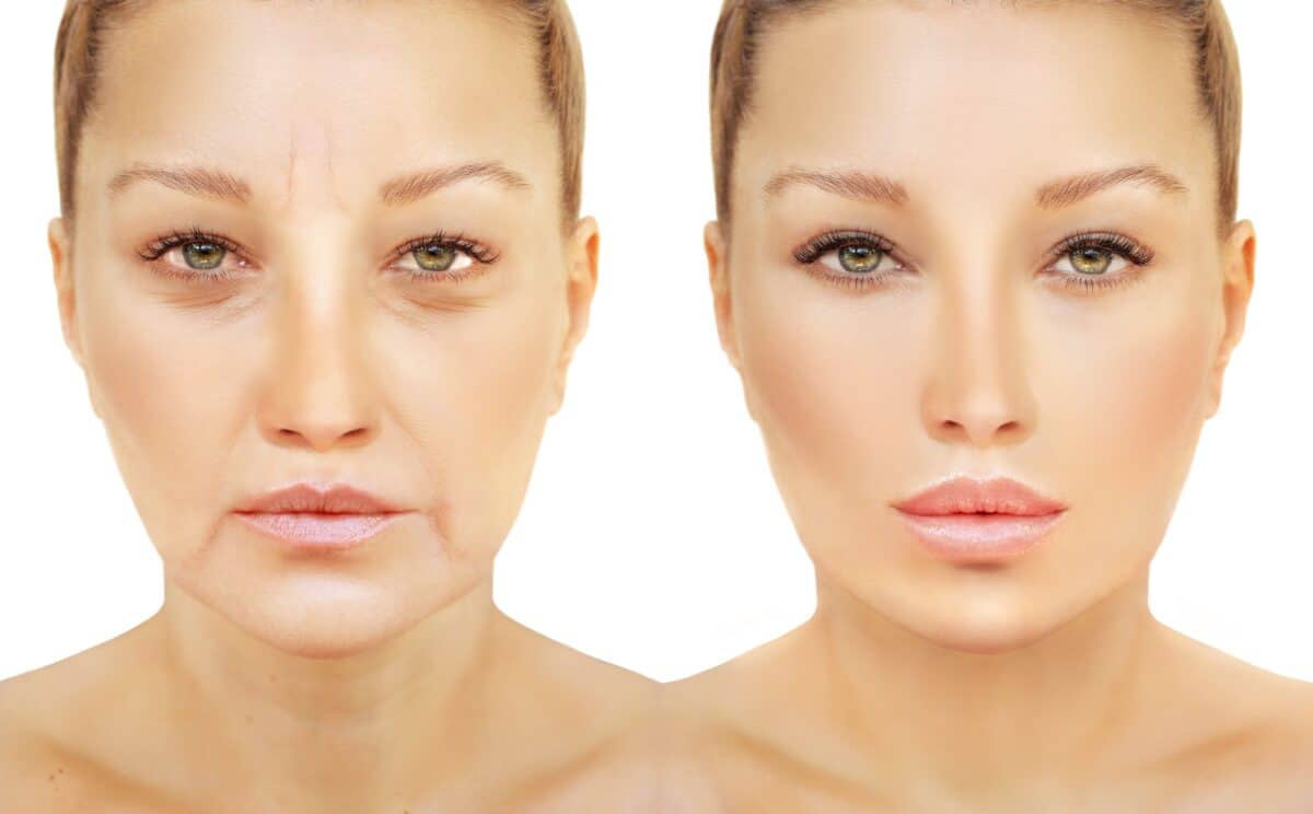 Woman before and after botox and fillers